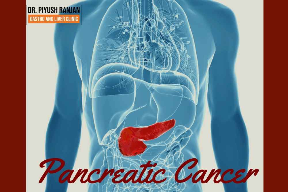 Read more about the article Pancreatic Cancer : Symptoms and Causes