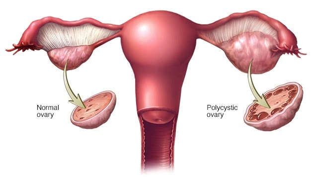 Read more about the article Polycystic Ovaries