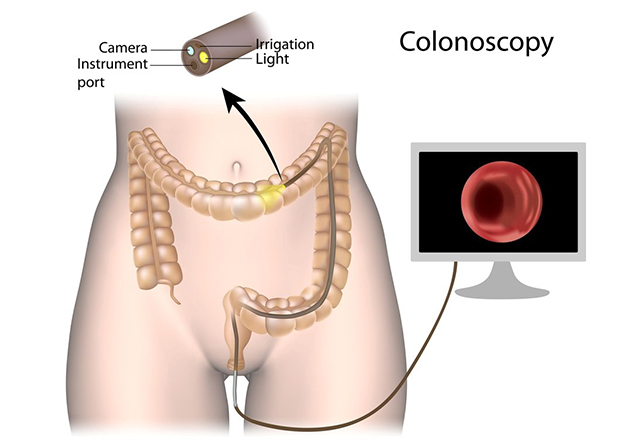 Read more about the article Colonoscopy