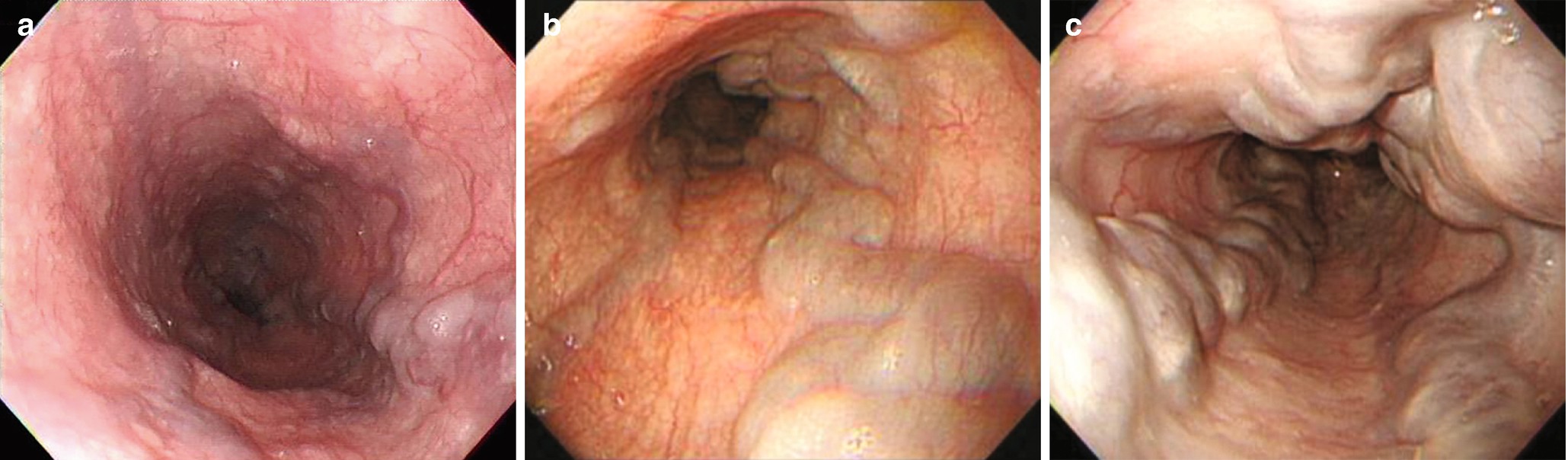 Read more about the article Endoscopic banding