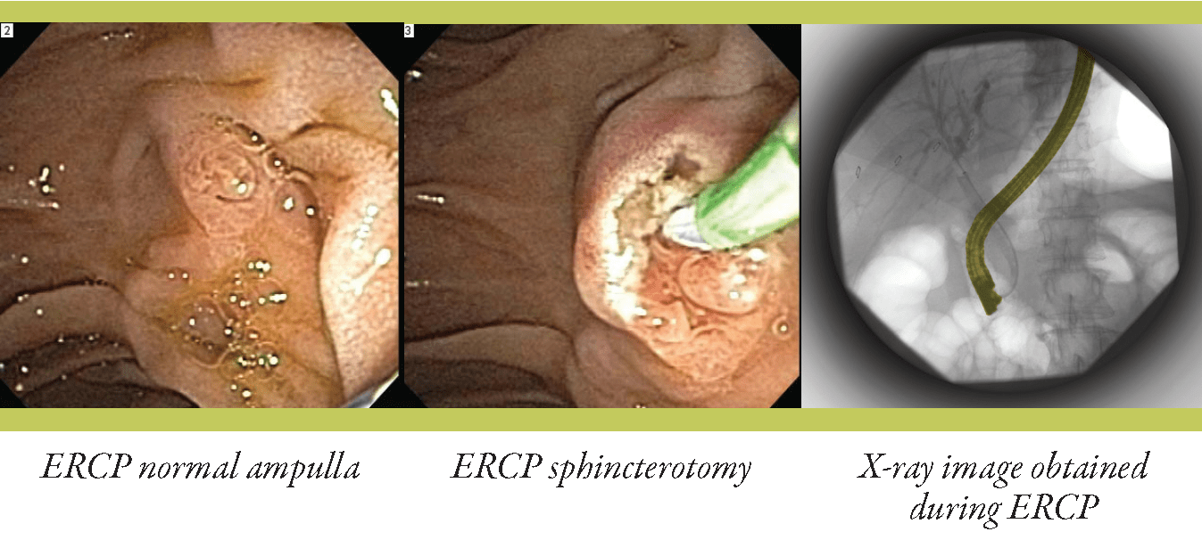 Read more about the article ERCP / Colonoscopy