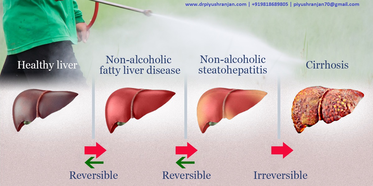 Read more about the article Fatty Liver Sign, Treatment And Cost in Delhi