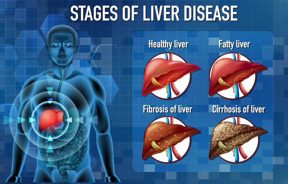 Read more about the article What Are the Four Stages of Liver Disease? Causes & Symptoms