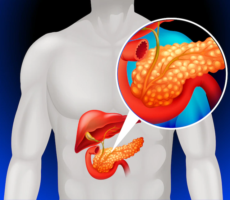 Read more about the article How to diagnose pancreatic cancer early?