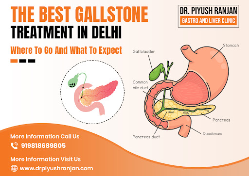 You are currently viewing The Best Gallstone Treatment in Delhi – Where to Go and What to Expect