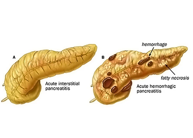 Chronic Pancreatitis Treatment in Delhi