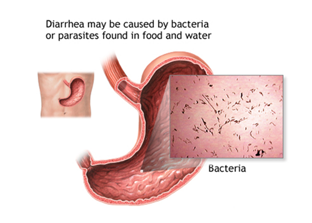 Diarrhea Treatment In Delhi