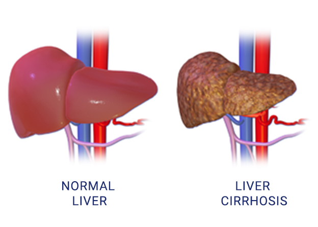 Liver Cirrhosis treatment In Delhi