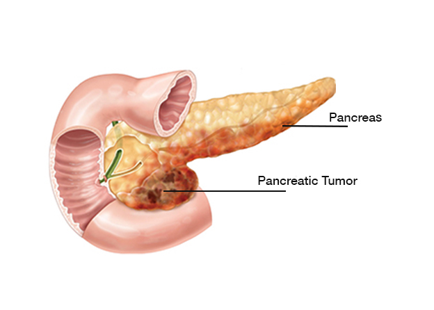 Pancreatic Cancer Treatment in Delhi