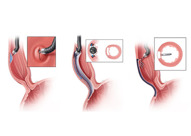 POEM- Peroral Endoscopic Myotomy In Delhi